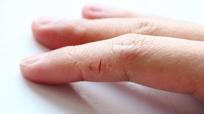 Quelques conseils pour soigner les crevasses des mains