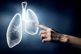 Le cancer du poumon chez la femme en passe de devenir une pandémie ?