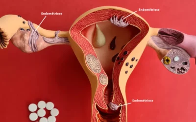 Endométriose : comment la détecter et la diagnostiquer pour un traitement précoce