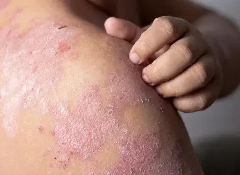 Eczema, un "enfer" pour la peau, mais il y a des solutions