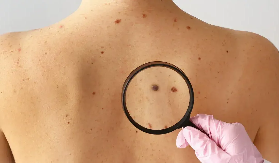 Relation entre cancer de la peau et UV